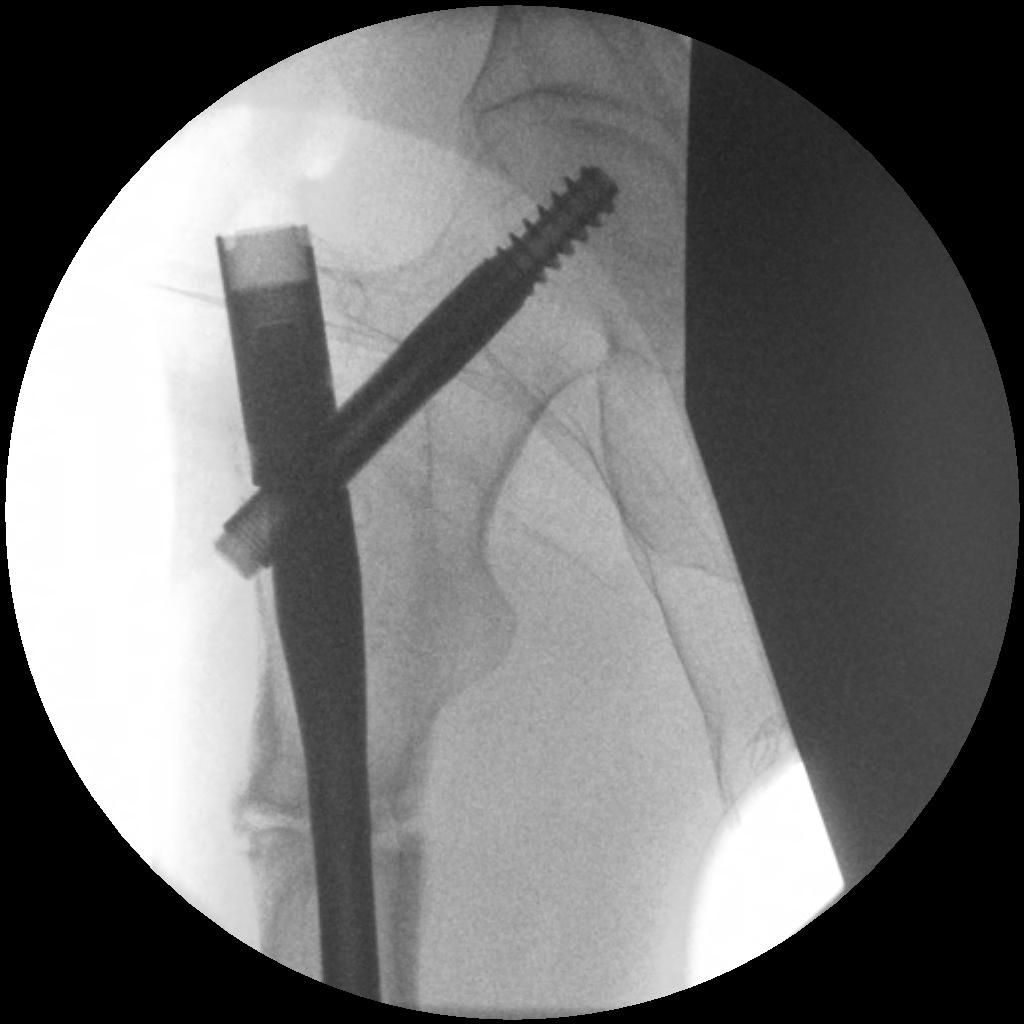 Femoral Stress Fracture IMN